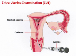 Intra Uterine insemination
